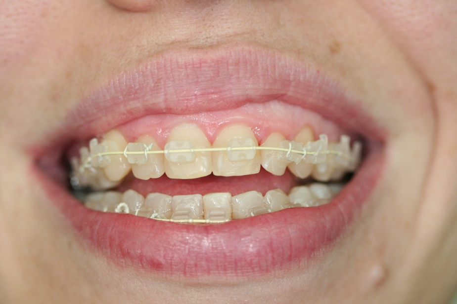 clear fixed braces